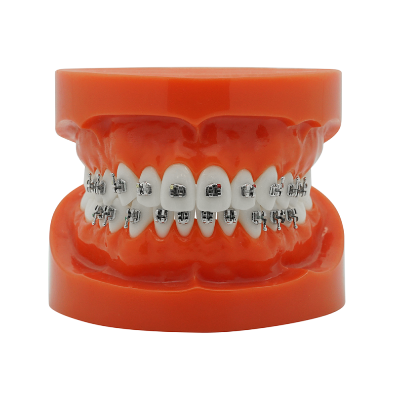 Günstiges KFO Metall Mini Bracket (Kostenloser EU Versand) Günstiges KFO Metall Mini Bracket (Kostenloser EU Versand)