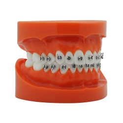 Günstiges KFO Metall Mini Bracket (Kostenloser EU Versand) Günstiges KFO Metall Mini Bracket (Kostenloser EU Versand)