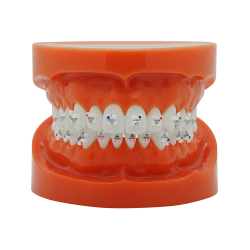 Selbstligierendes Keramikbracket (Kostenloser Versand) Selbstligierendes Keramikbracket (Kostenloser Versand)