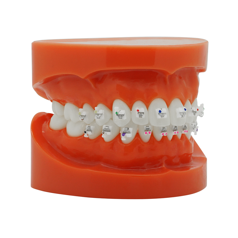Selbstligierendes Keramikbracket (Kostenloser Versand) Selbstligierendes Keramikbracket (Kostenloser Versand)
