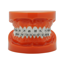 Selbstligierendes Metallbracket (Kostenloser Versand)