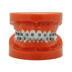 Smart Slide Selbstligierendes Metallbracket (Kostenloser Versand) Smart Slide Selbstligierendes Metallbracket (Kostenloser Versand)