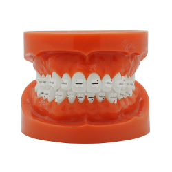 KFO Keramikbracket mit Metallslot (Kostenloser EU Versand)