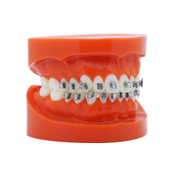 Smart Slide Selbstligierendes Metallbracket (Kostenloser Versand) Smart Slide Selbstligierendes Metallbracket (Kostenloser Versand)