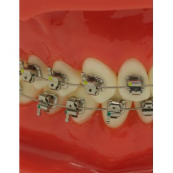 Selbstligierendes Metallbracket (Kostenloser Versand) Selbstligierendes Metallbracket (Kostenloser Versand)