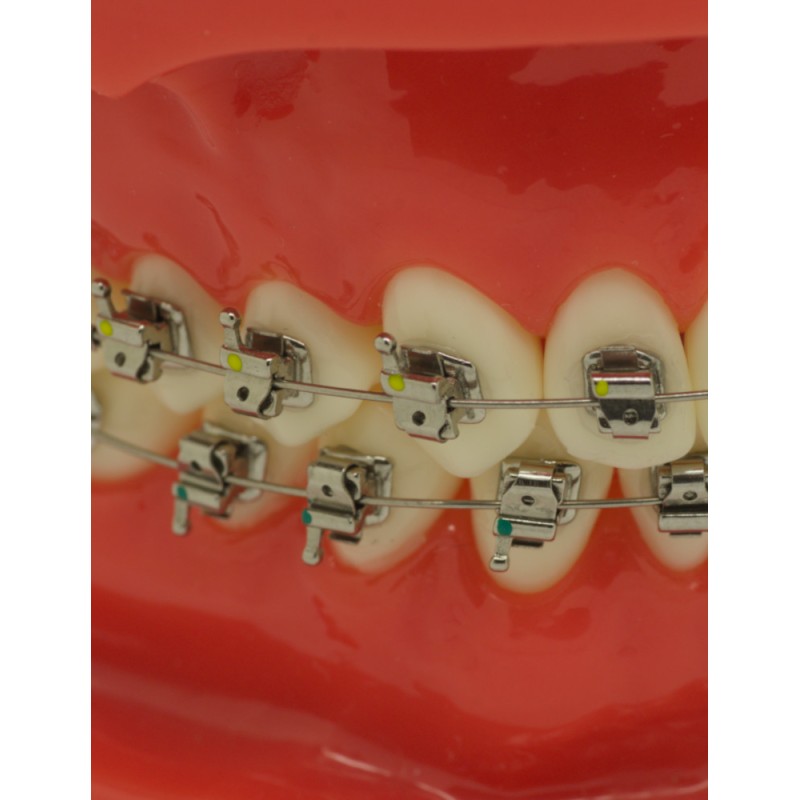 Selbstligierendes Metallbracket (Kostenloser Versand) Selbstligierendes Metallbracket (Kostenloser Versand)