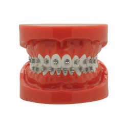 Selbstligierendes Metallbracket (Kostenloser Versand)