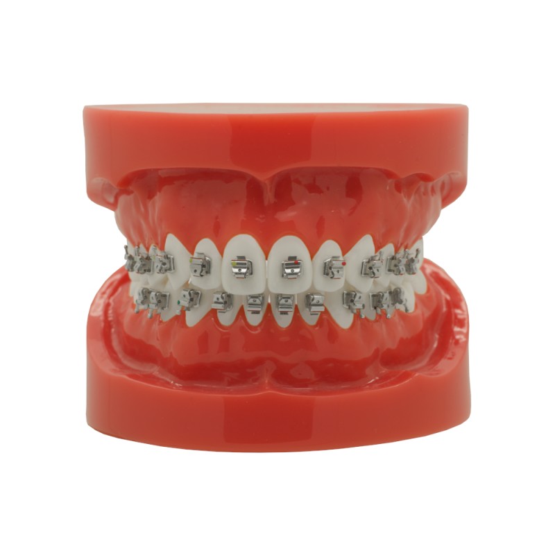 Selbstligierendes Metallbracket (Kostenloser Versand) Selbstligierendes Metallbracket (Kostenloser Versand)