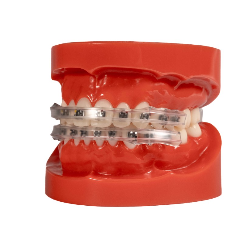 Lippenschutz für Brackets ( 2x )