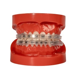 Lippenschutz für Brackets ( 2x )