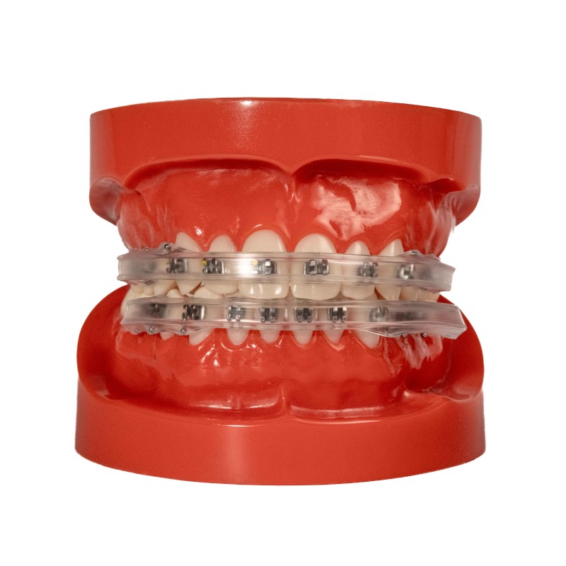 Lippenschutz für Brackets ( 2x )