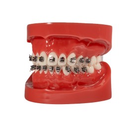 Selbstligierendes Metallbracket (Kostenloser Versand)