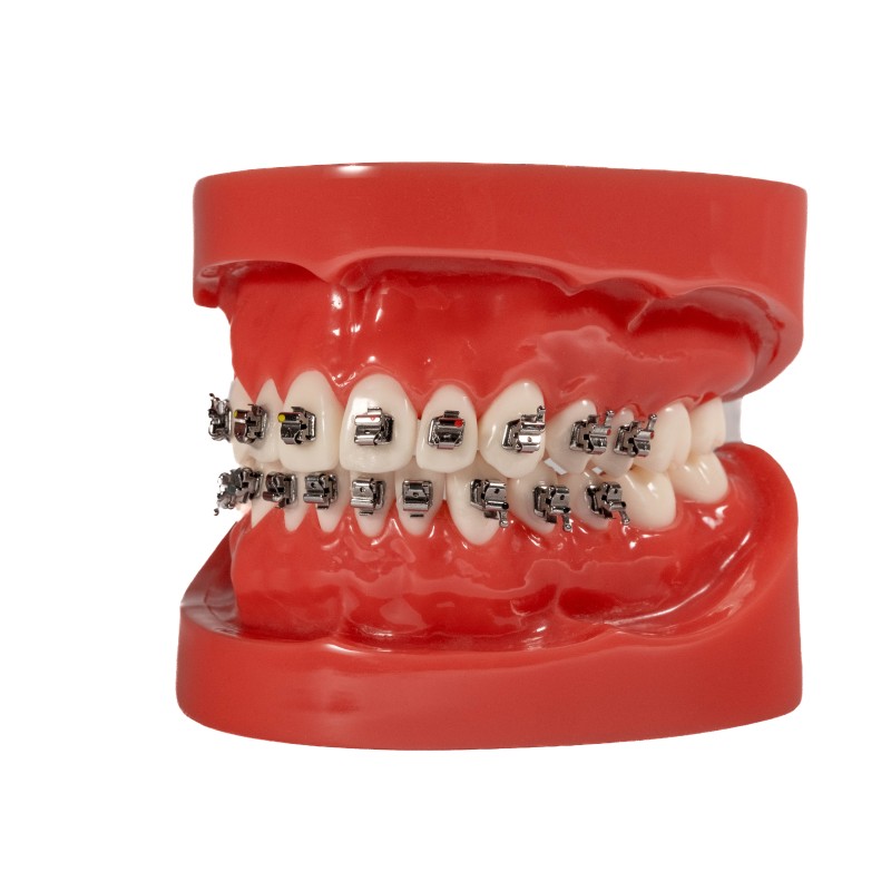 Selbstligierendes Metallbracket (Kostenloser Versand)