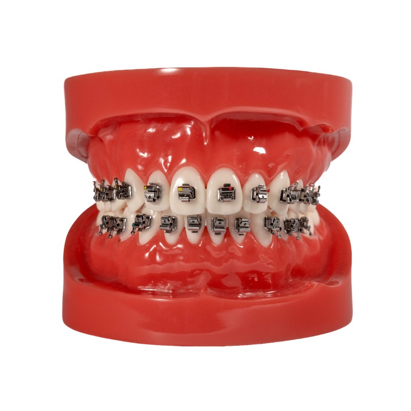 Selbstligierendes Metallbracket (Kostenloser Versand)